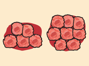 Icoon dat het kankerstadium bij diagnose vertegenwoordigt